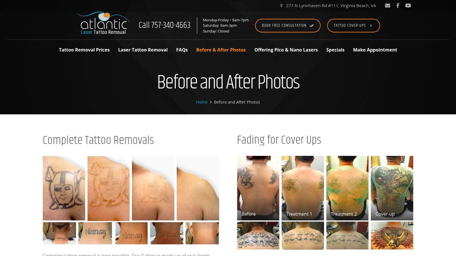 Atlantic Laser Tattoo Removal