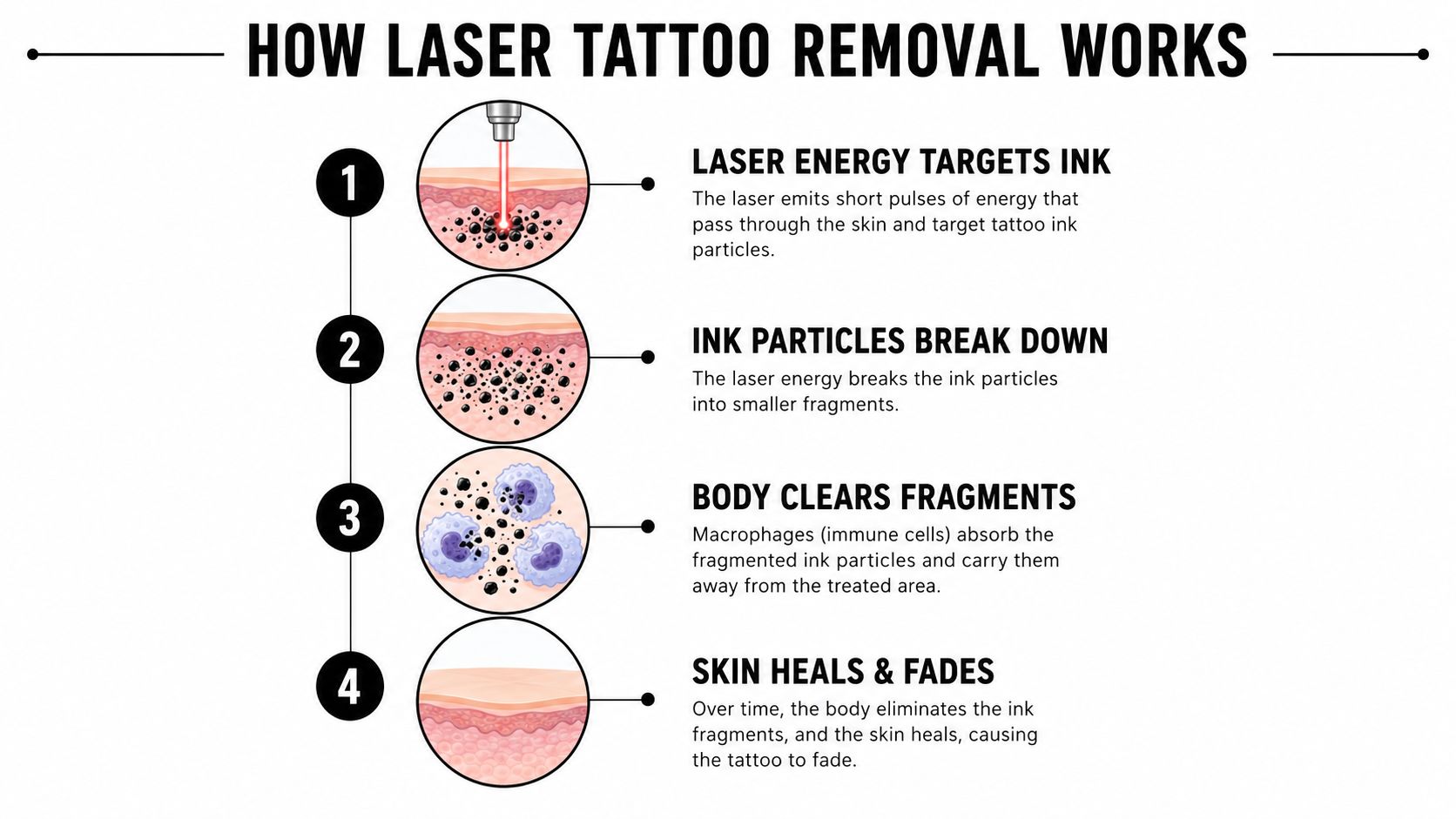 A four-step infographic showing how laser tattoo removal breaks down ink particles within the human skin.