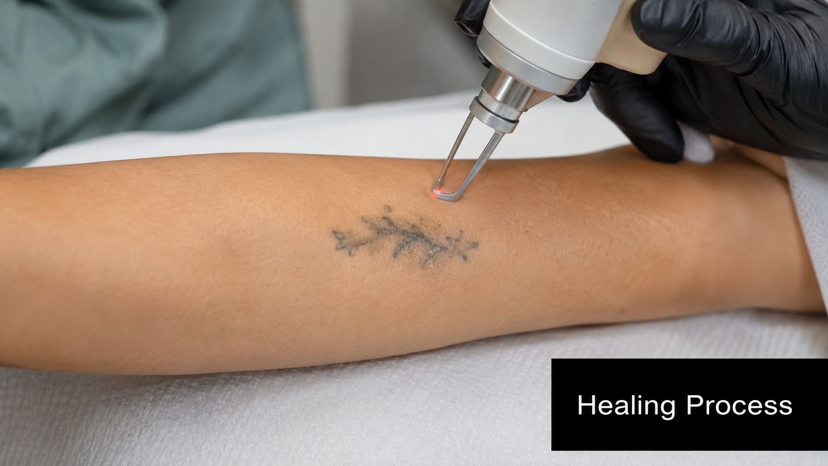 A professional laser technician removes a small tattoo from a patient's arm during a clinical procedure session.