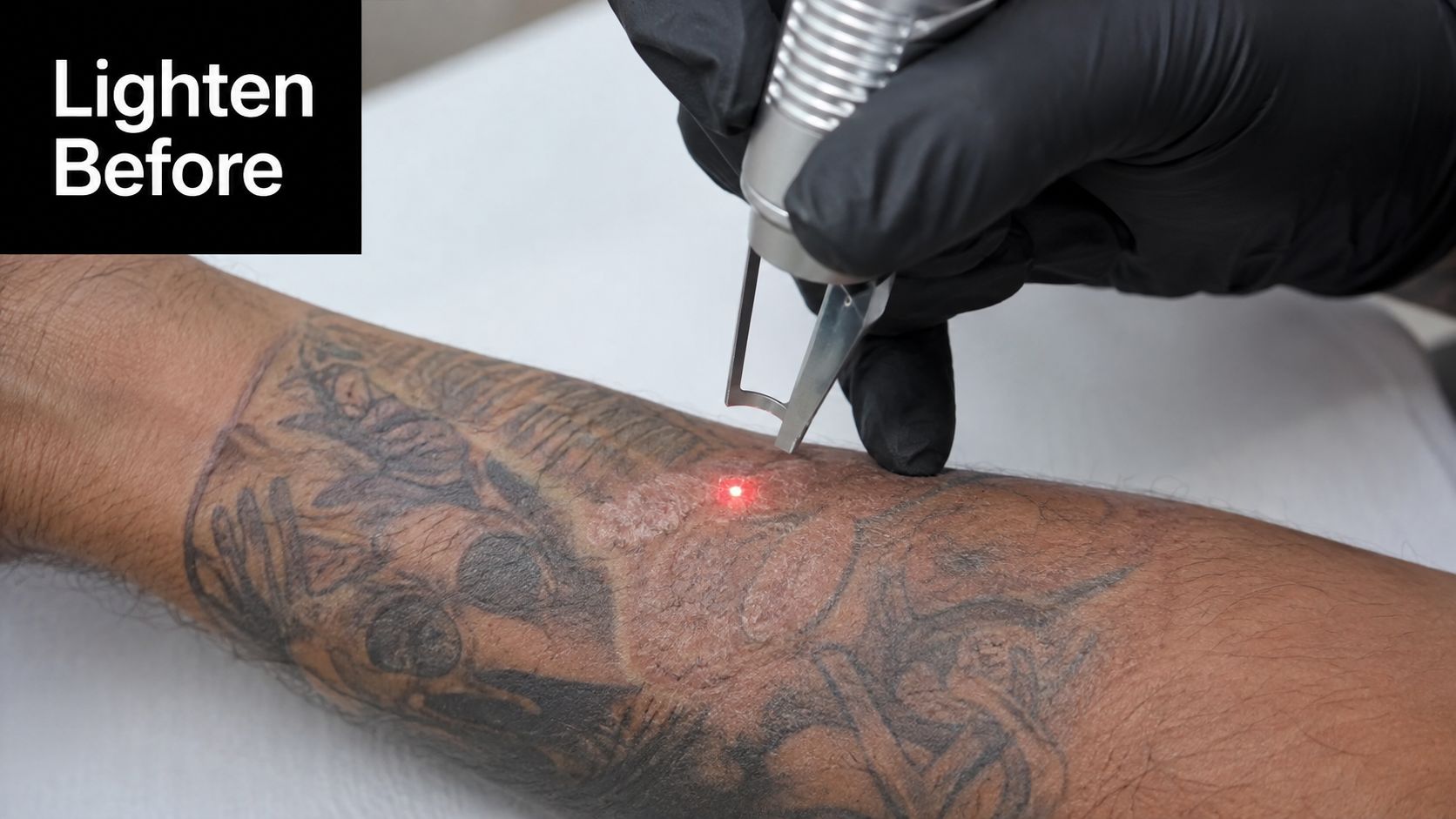 A gloved practitioner performs laser tattoo removal on a person's forearm, targeting a dark ink area.