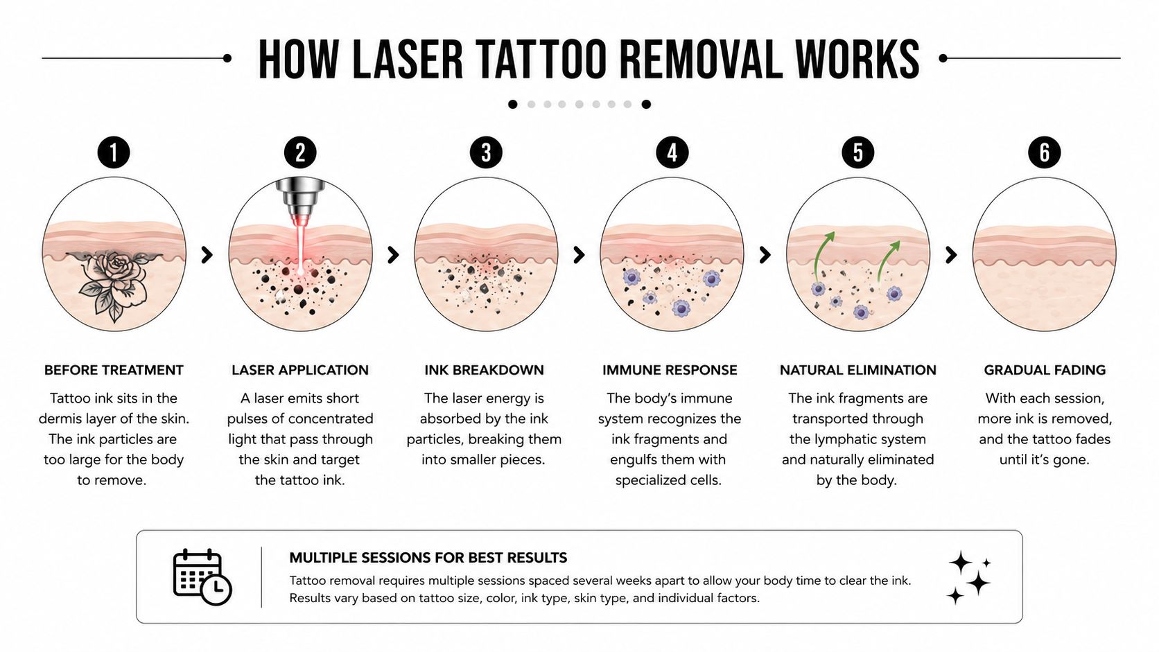 A six-step infographic explaining how laser tattoo removal works by breaking down ink particles for elimination.