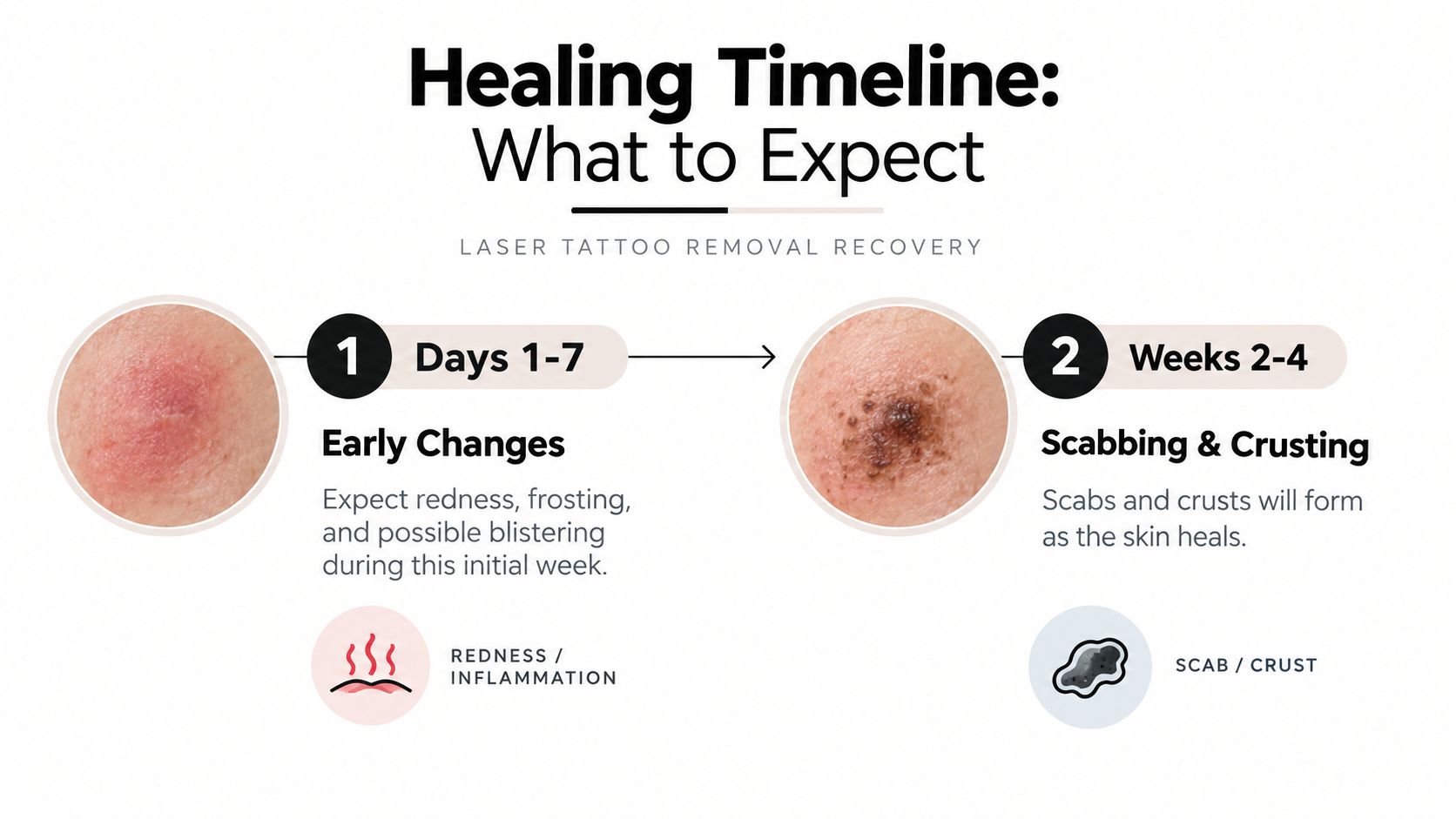A visual guide showing the laser tattoo removal recovery healing timeline during the first four weeks.