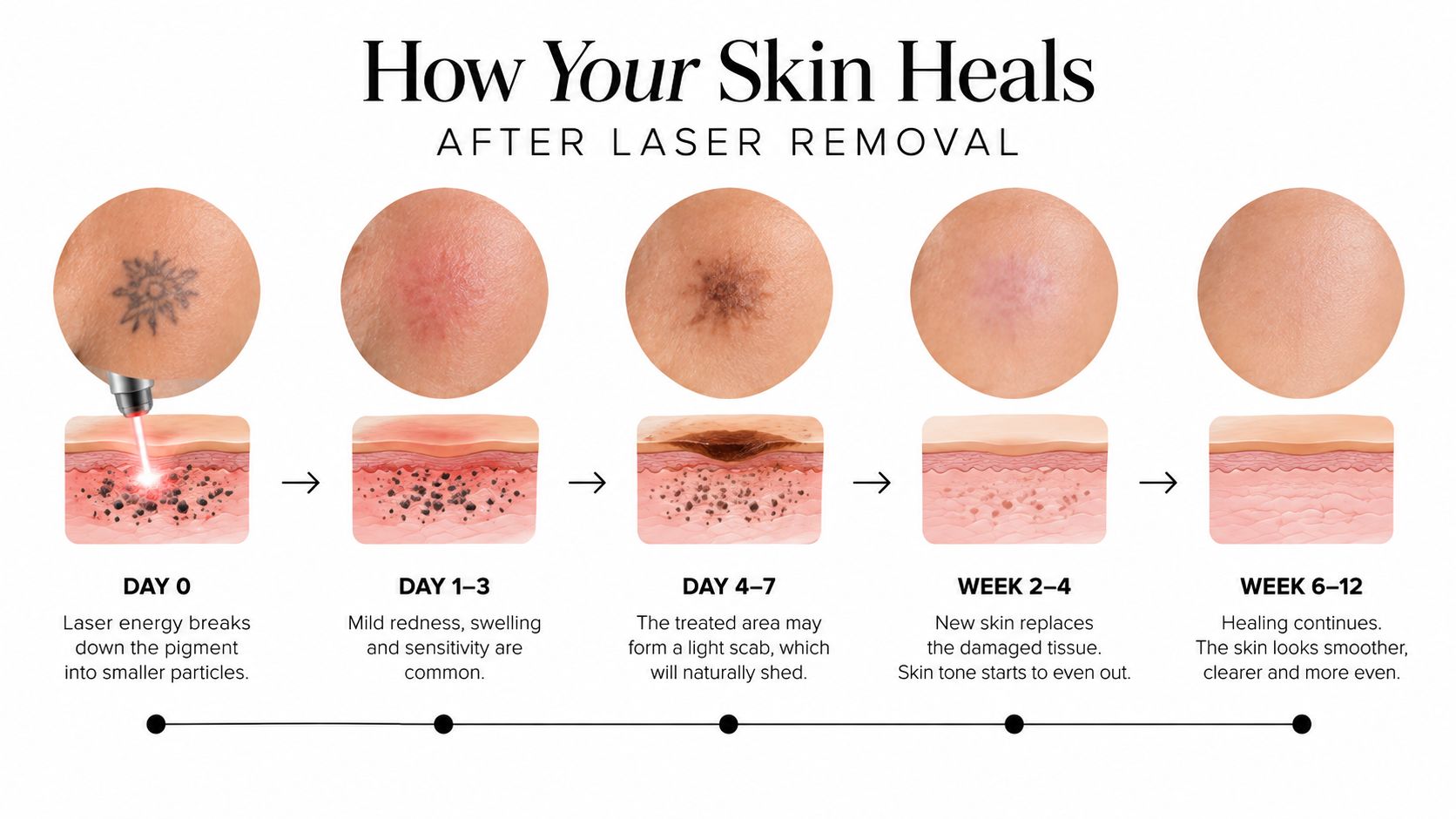 An infographic showing the five-stage skin healing process following a professional laser tattoo removal treatment.
