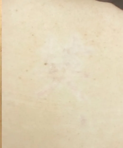 Laser tattoo removal after: black ink shoulder tattoo, real EradiTatt patient