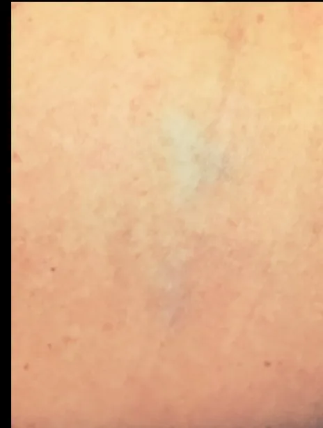 Laser tattoo removal after: color rose tattoo, real EradiTatt patient