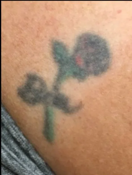 Laser tattoo removal before: color rose tattoo, real EradiTatt patient
