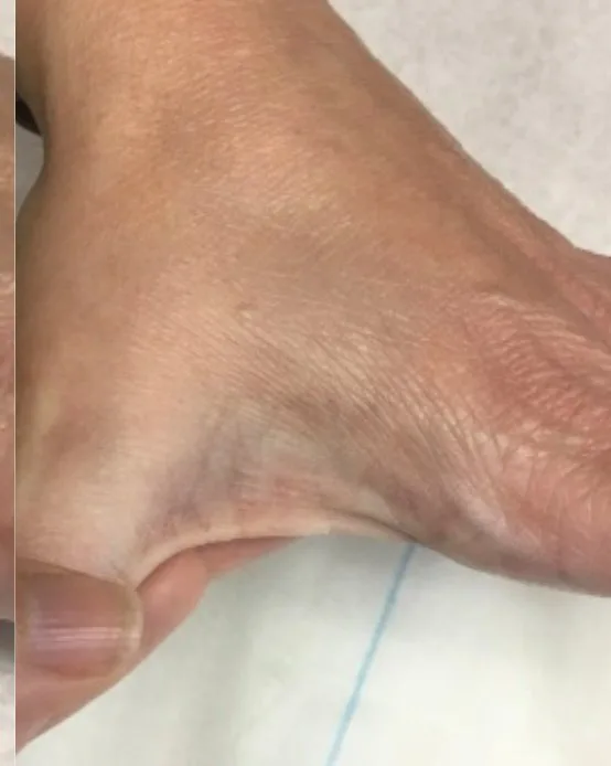 Laser tattoo removal after: name lettering tattoo, real EradiTatt patient