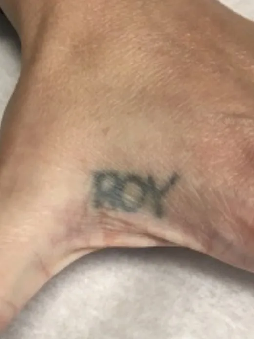 Laser tattoo removal before: name lettering tattoo, real EradiTatt patient