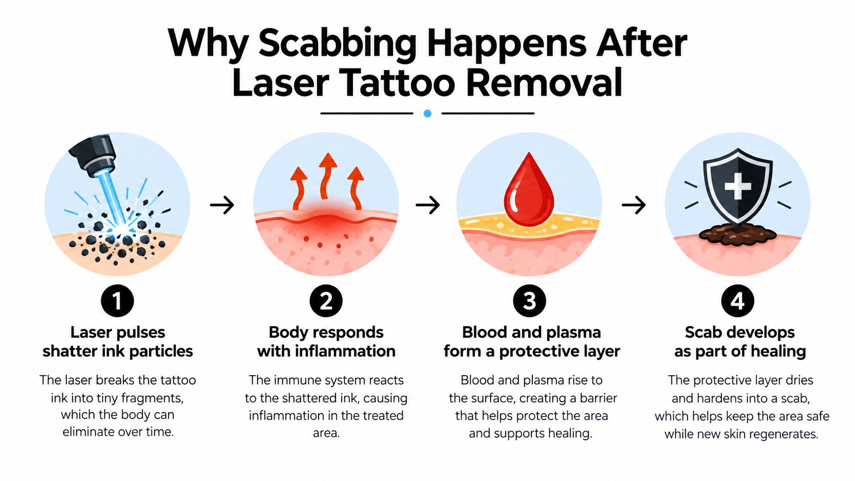 A four-step infographic illustrating the biological process of scab formation after a laser tattoo removal treatment.