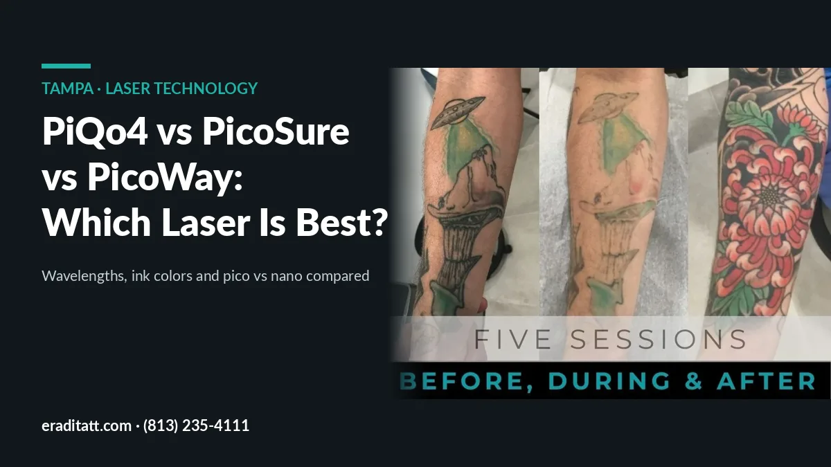 Forearm green and black tattoo faded in 5 sessions then covered; PiQo4 vs PicoSure vs PicoWay, Tampa