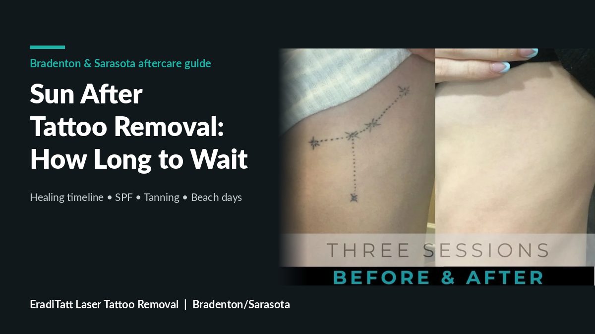 Before and after of a dotted constellation rib tattoo faded in three sessions, sun after tattoo removal guide, Bradenton
